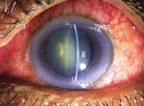 Acute Angle-Closure Attack