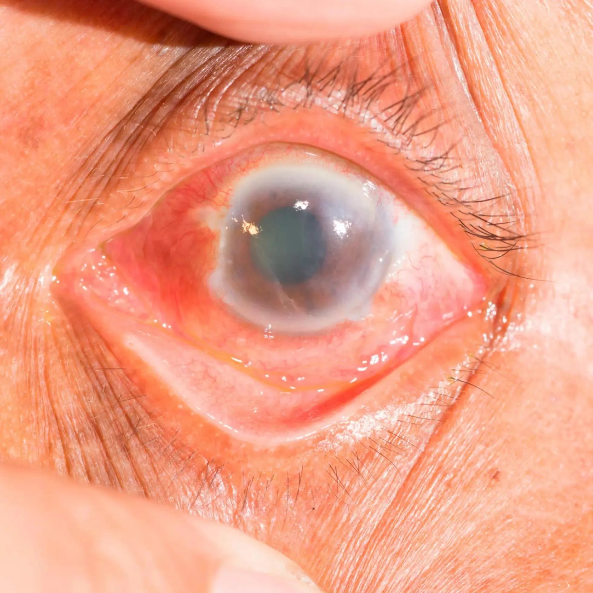 Acute Angle-Closure Glaucoma (Red eye)