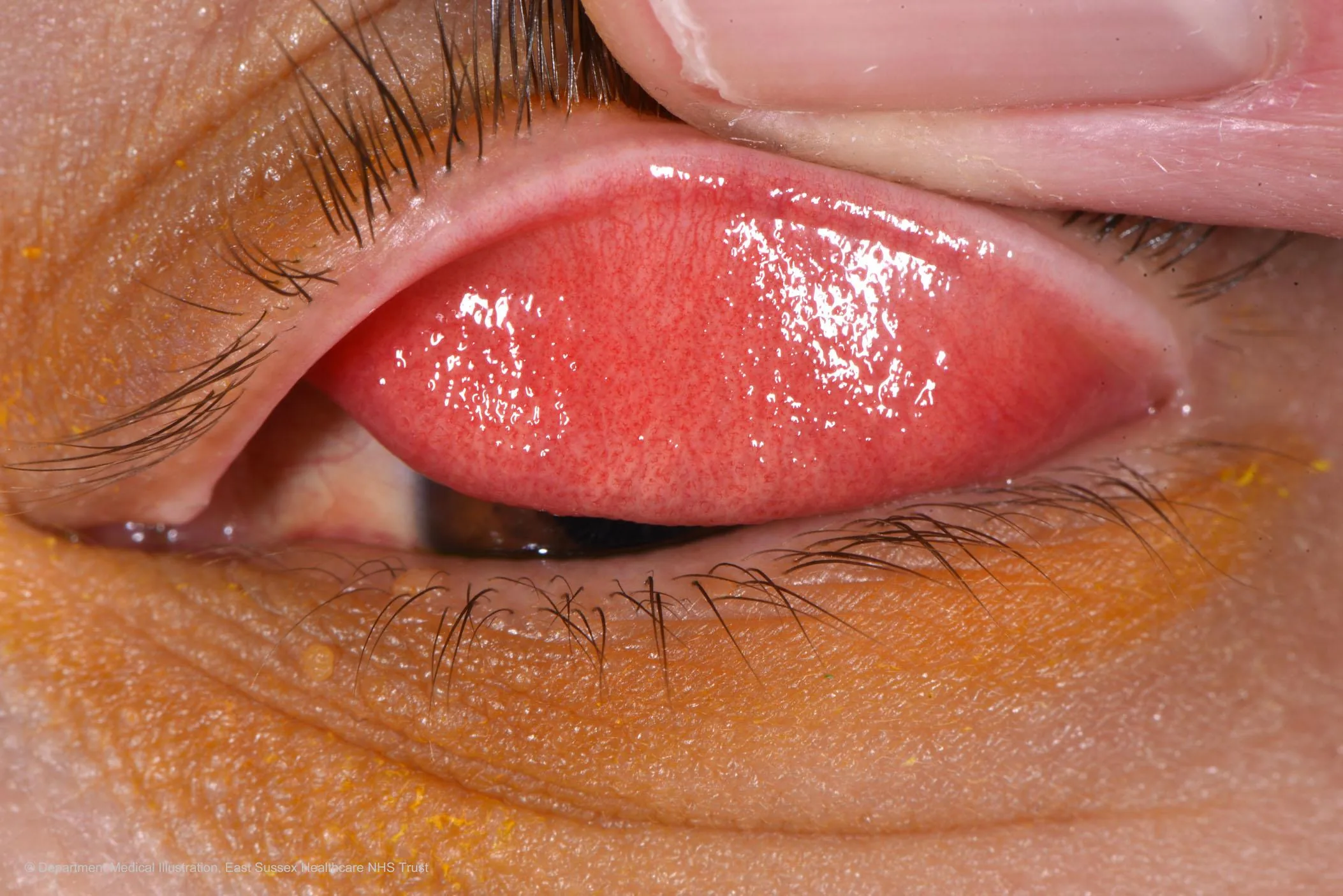 Allergic Conjunctivitis (Bilateral redness & severe itching)