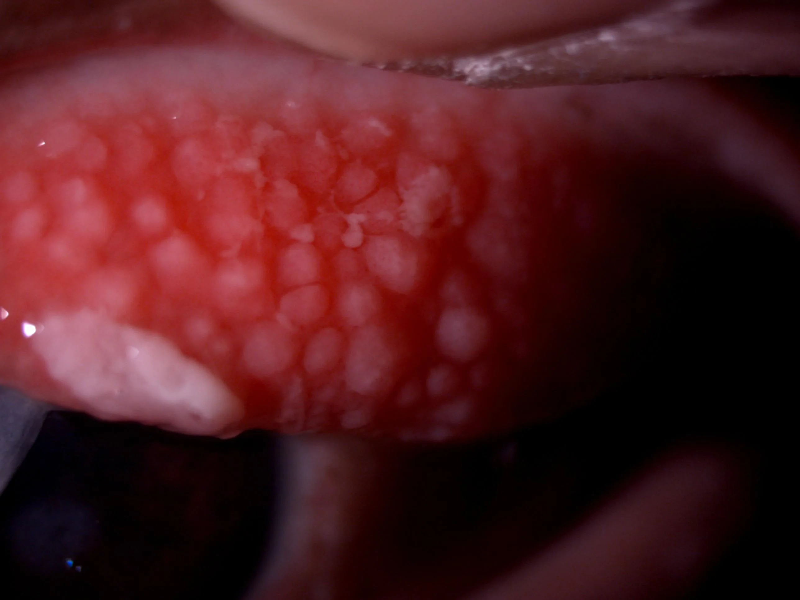 Allergic Conjunctivitis (Papillary reaction)