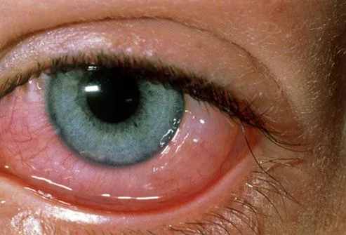 Allergic Conjunctivitis (Chemosis)