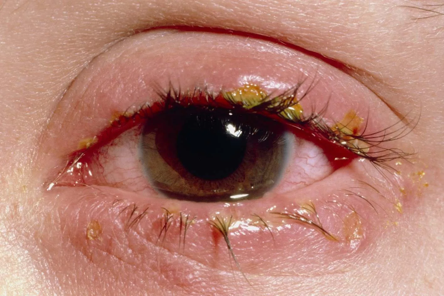 Bacterial Conjunctivitis (Marked redness & purulent discharge)