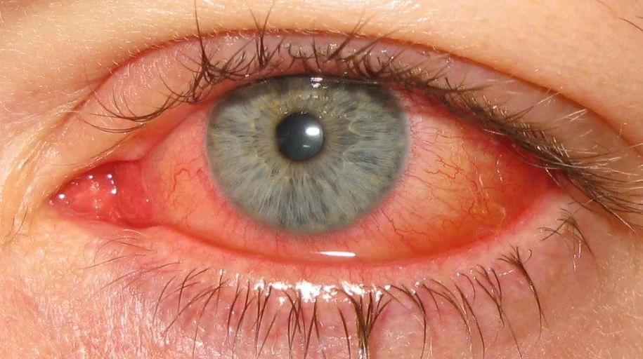Acute Conjunctivitis (Hyperemia and chemosis)