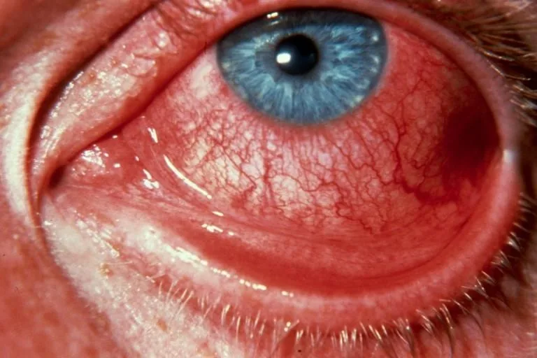 Acute Conjunctivitis (Diffuse redness)