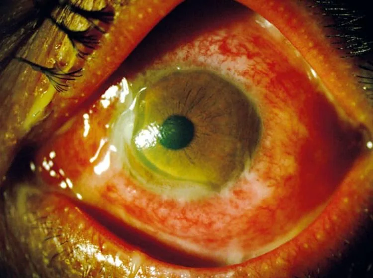Gonococcal Conjunctivitis (Severe chemosis)