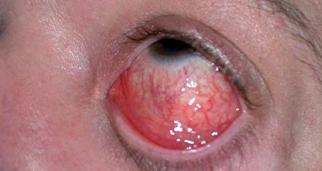 Hyperacute Conjunctivitis (High risk of corneal complications)