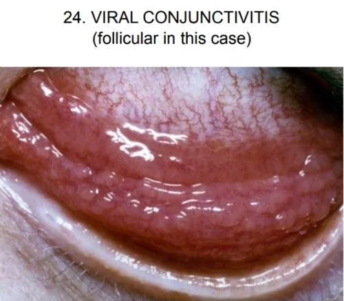 Viral Conjunctivitis (Follicular reaction & watery discharge)