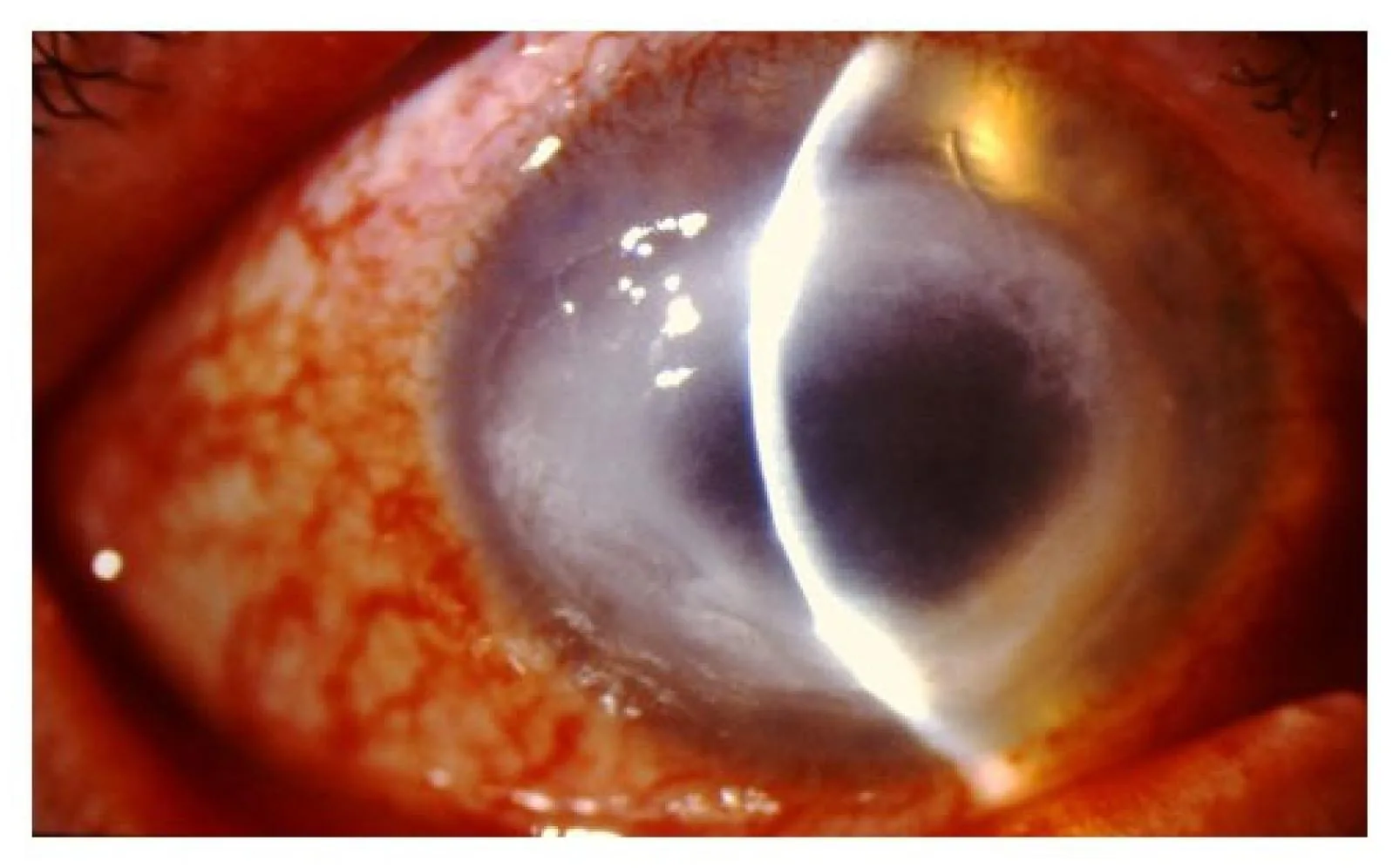 Acanthamoeba Keratitis (Detailed view)