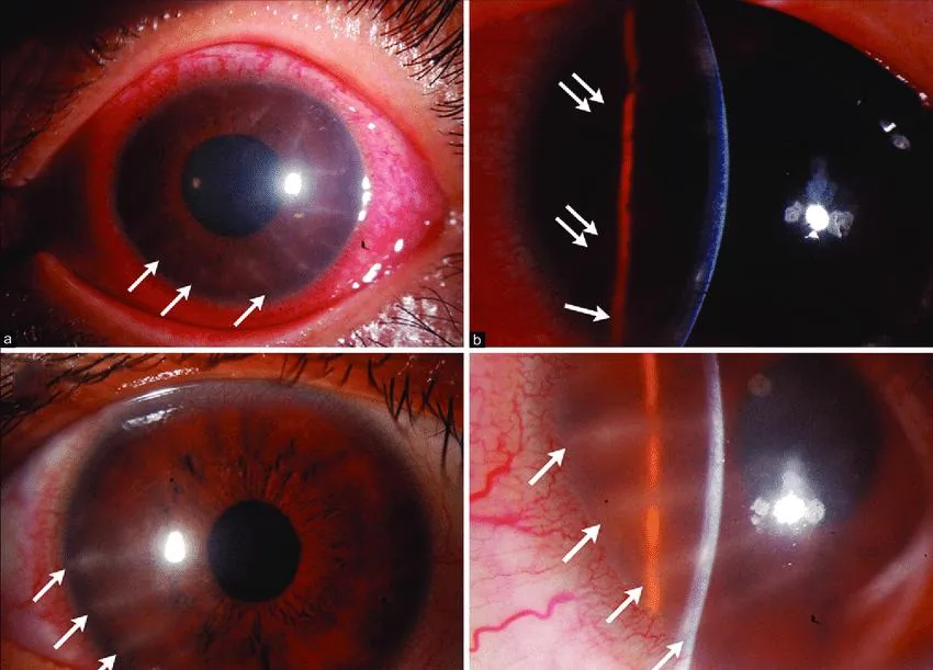 Perineural Infiltrates
