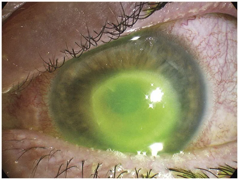 Dense Stromal Ring Infiltrate