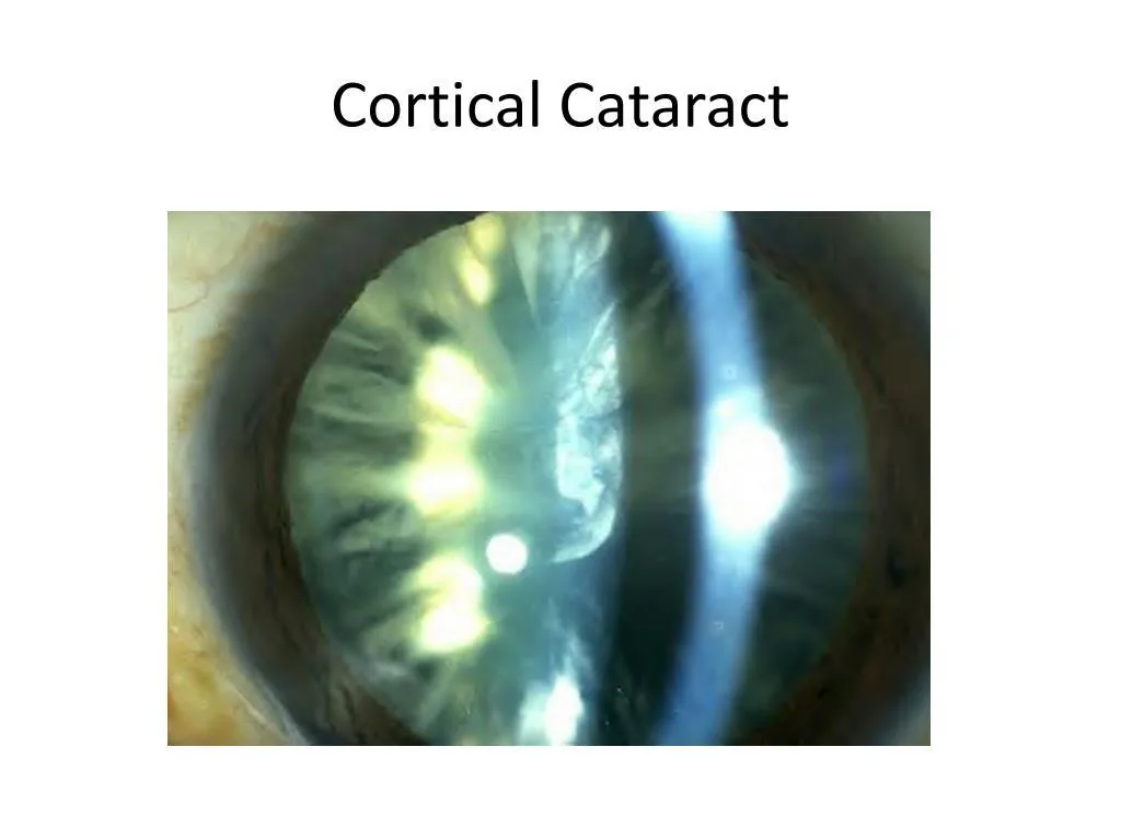 Cortical Cataract