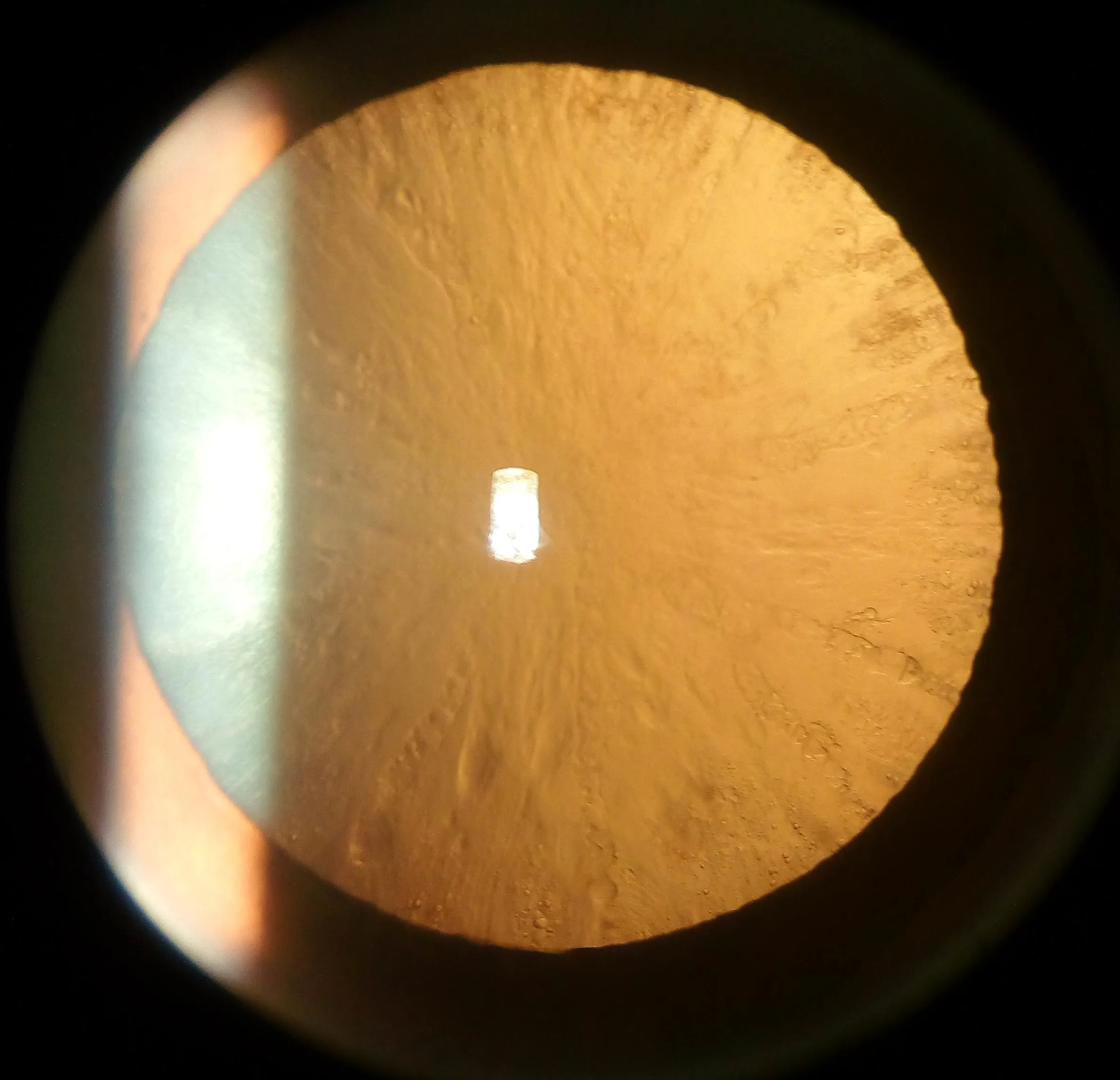 Cortical Cataract (Retroillumination)
