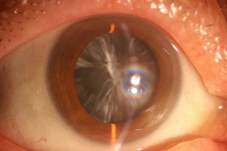 Cortical Cataract Spoke-like Opacities
