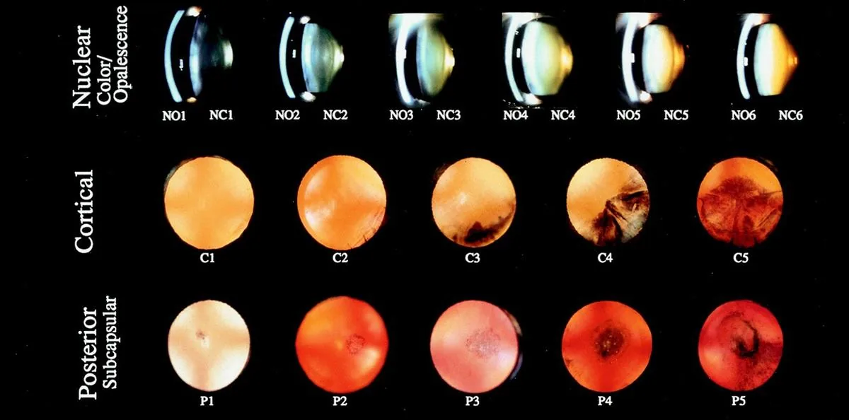 Cataract Grading System