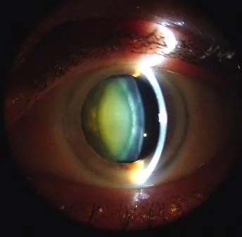 Nuclear Sclerotic Cataract (Advanced)