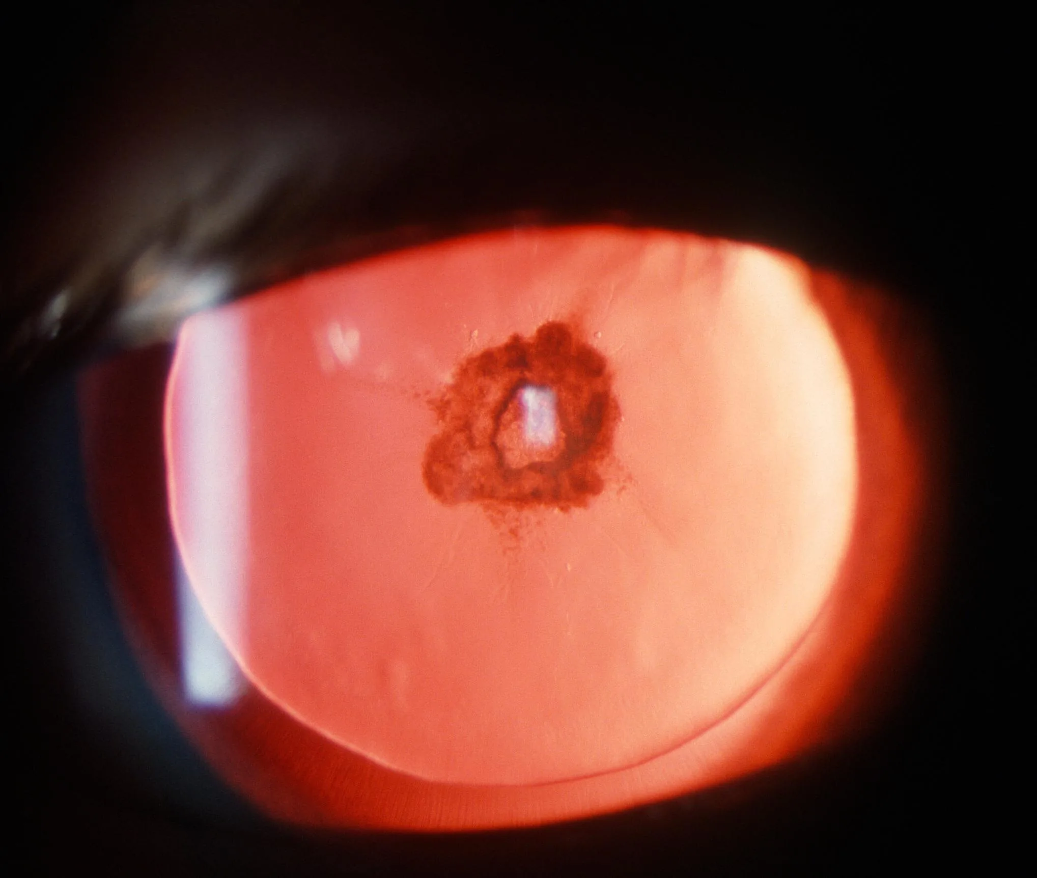 Posterior Subcapsular Cataract (PSC)