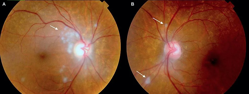 Giant Cell Arteritis - Optic disc swelling (AION)