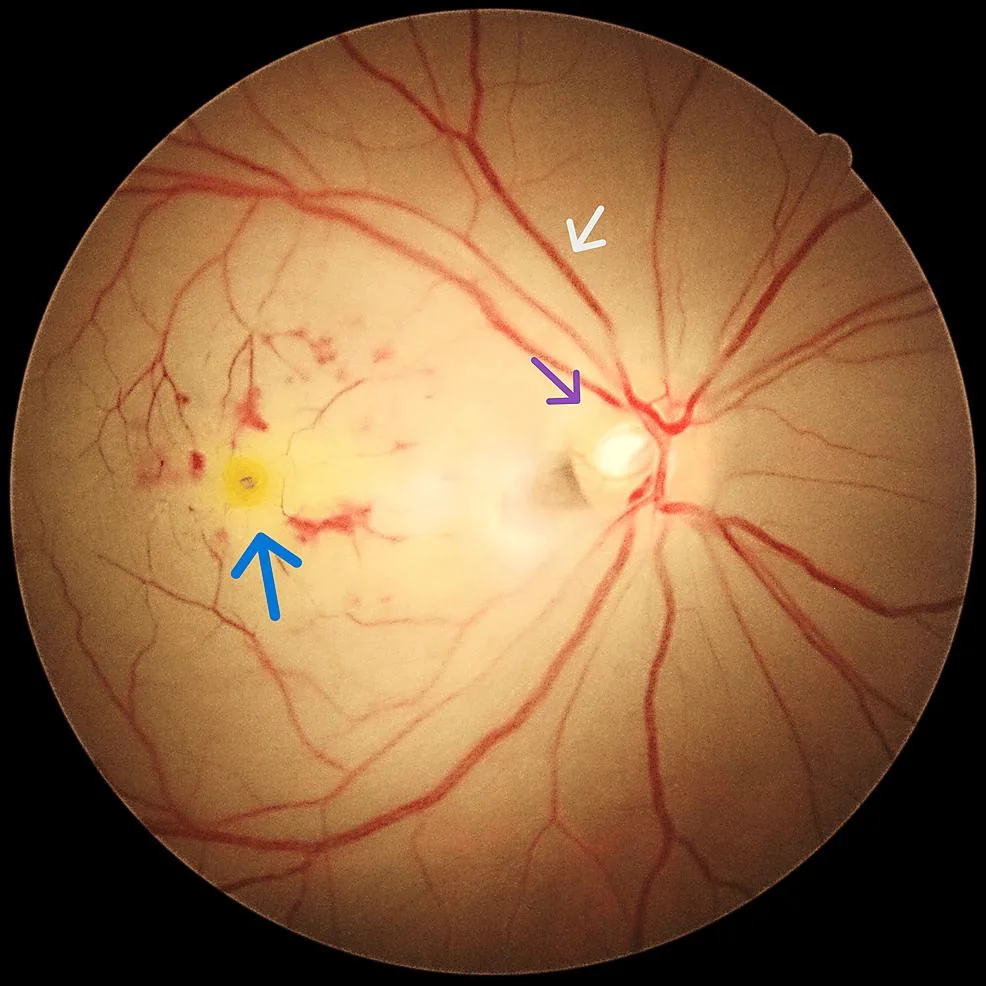 Giant Cell Arteritis - Ischemic changes