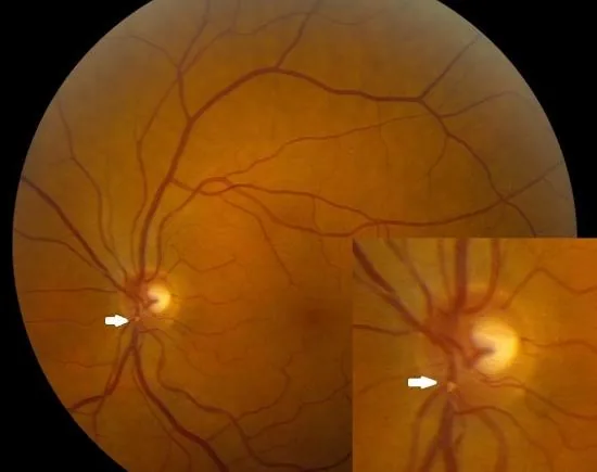 Hollenhorst Plaque (Fundus view)