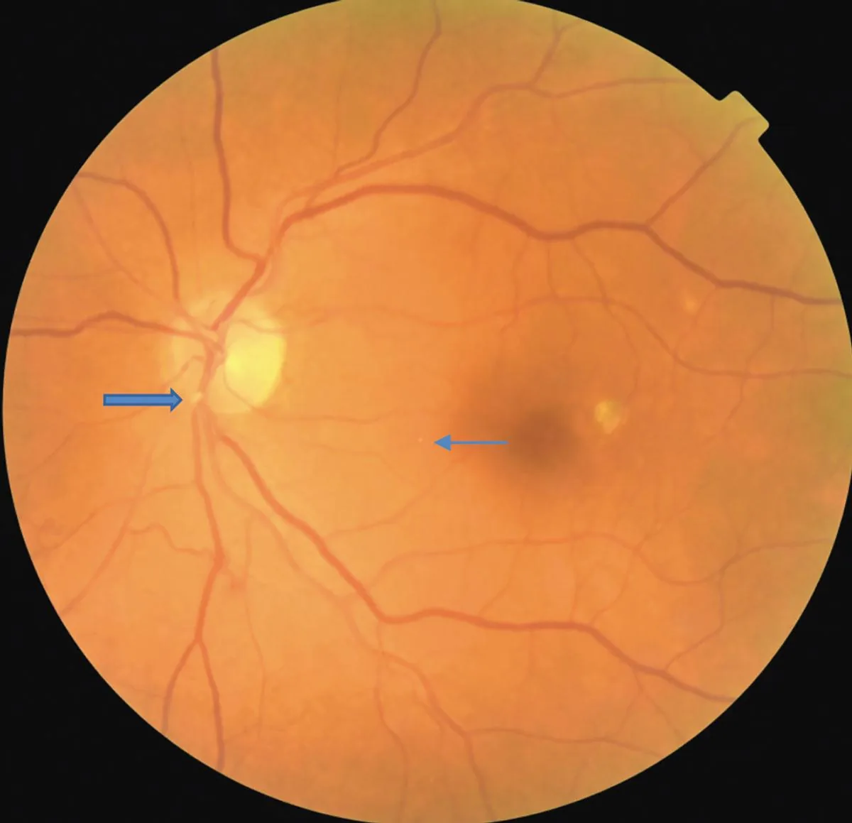 Retinal embolus causing transient ischemia