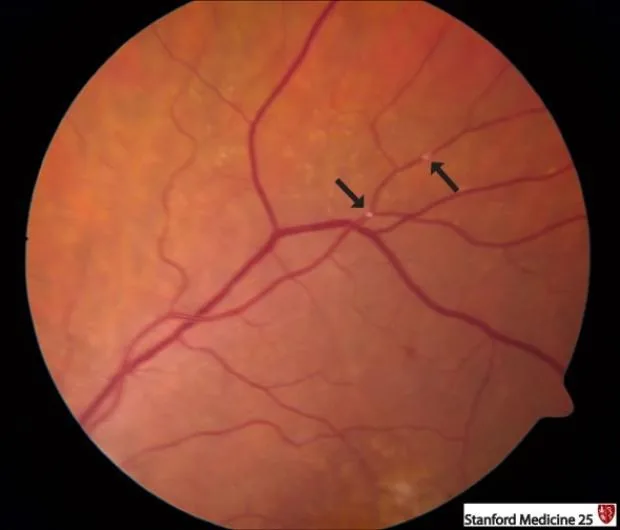 Retinal whitening and ischemia due to embolus