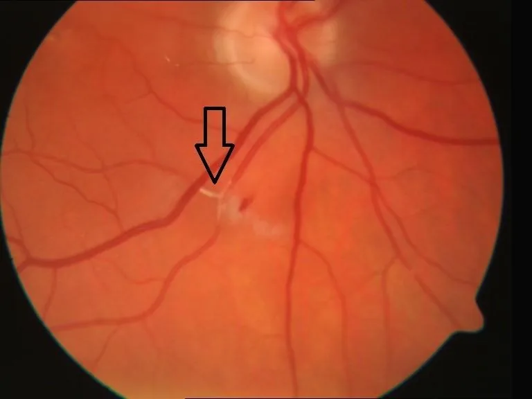 Branch Retinal Artery Occlusion (BRAO)