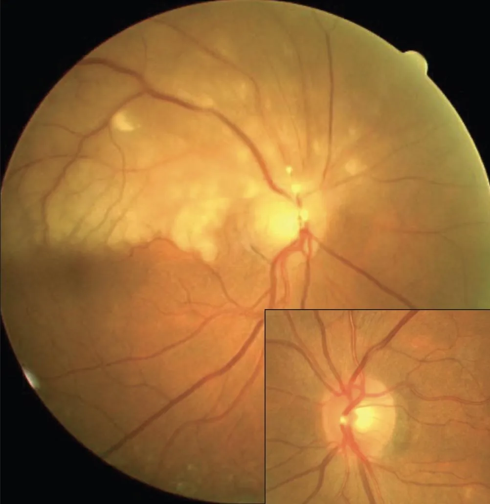 Extensive retinal pallor following embolic event