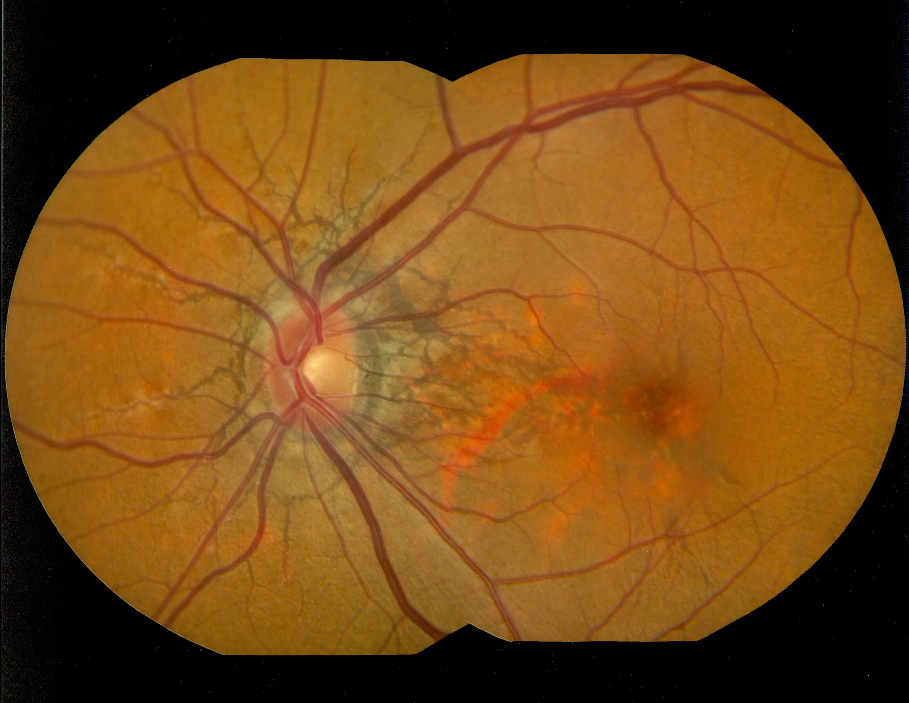 Classic Angioid Streaks radiating from the optic disc