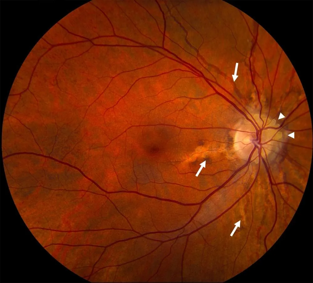 Peripapillary Angioid Streaks