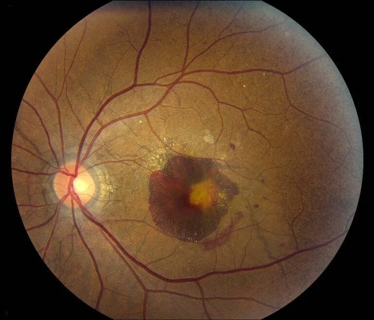 Choroidal Neovascularization (CNV) secondary to streaks