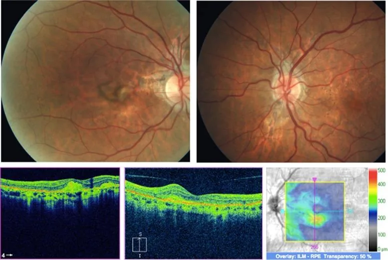 Subretinal hemorrhage secondary to CNV