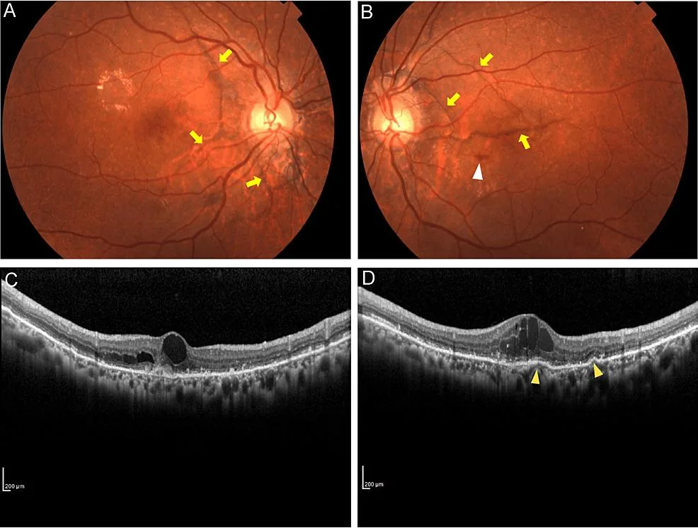 Fundus Autofluorescence (FAF) highlighting streaks