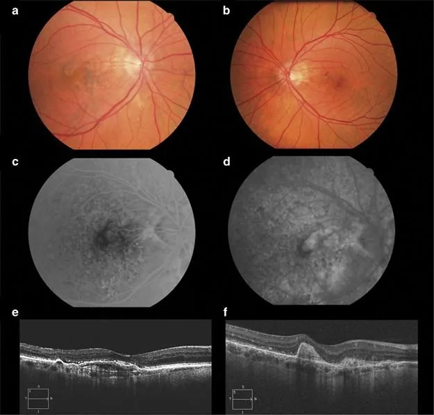 Multimodal imaging of Angioid Streaks