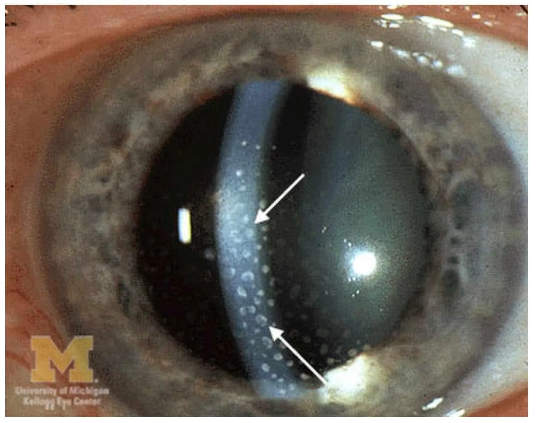 Dense cellular reaction (Iritis)