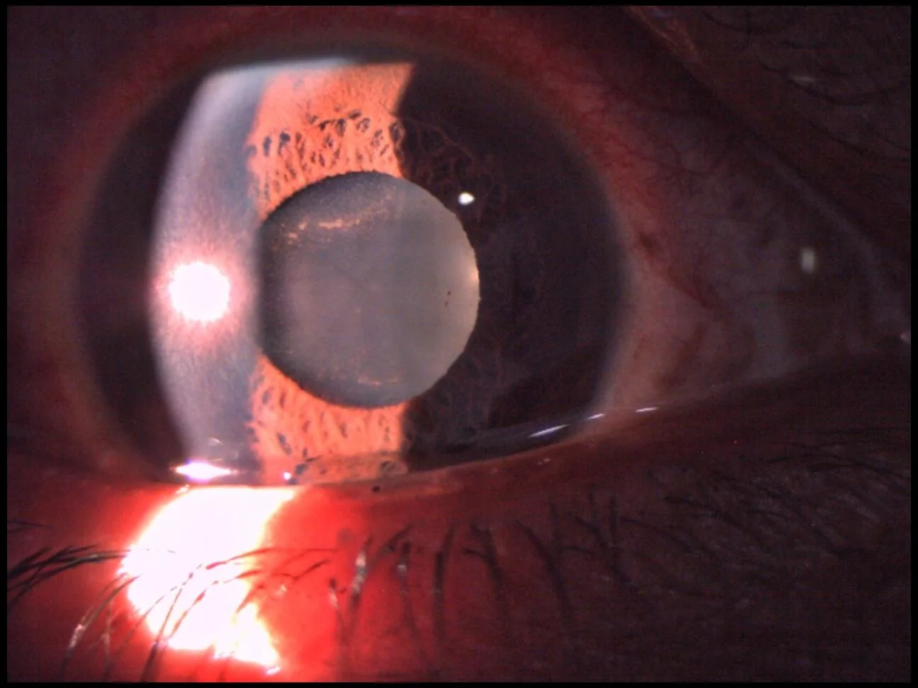 Intense anterior chamber inflammation with fibrin and early hypopyon