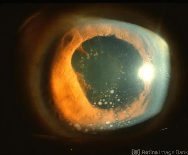 Large, greasy Mutton-Fat KPs on the corneal endothelium