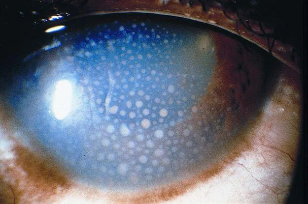 Close-up of Mutton-Fat KP (Granulomatous)