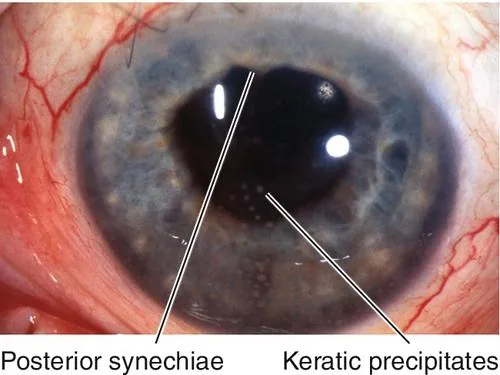 Posterior Synechiae (Adhesions between iris and lens)