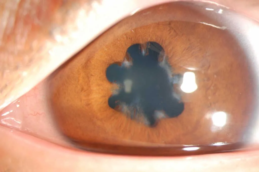 Pigment on the lens capsule from broken synechiae
