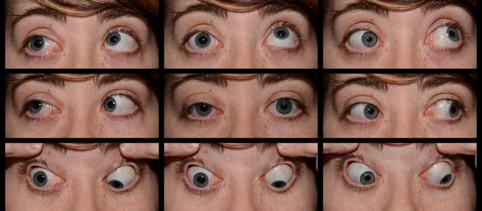 Synkinesis signs on clinical examination