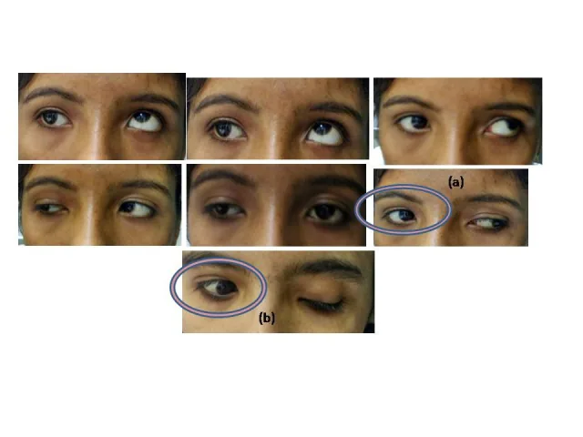 Pre-operative photographs showing exotropia and lid synkinesis