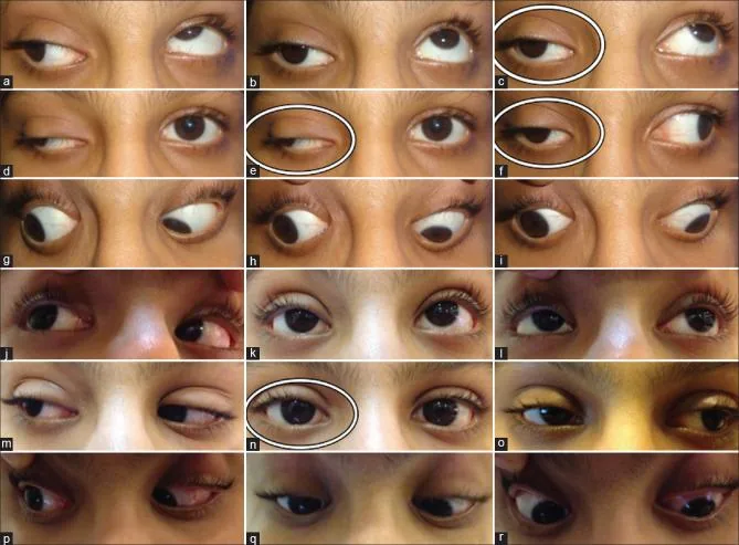 9-Gaze Examination: Demonstrating pseudo-von Graefe sign