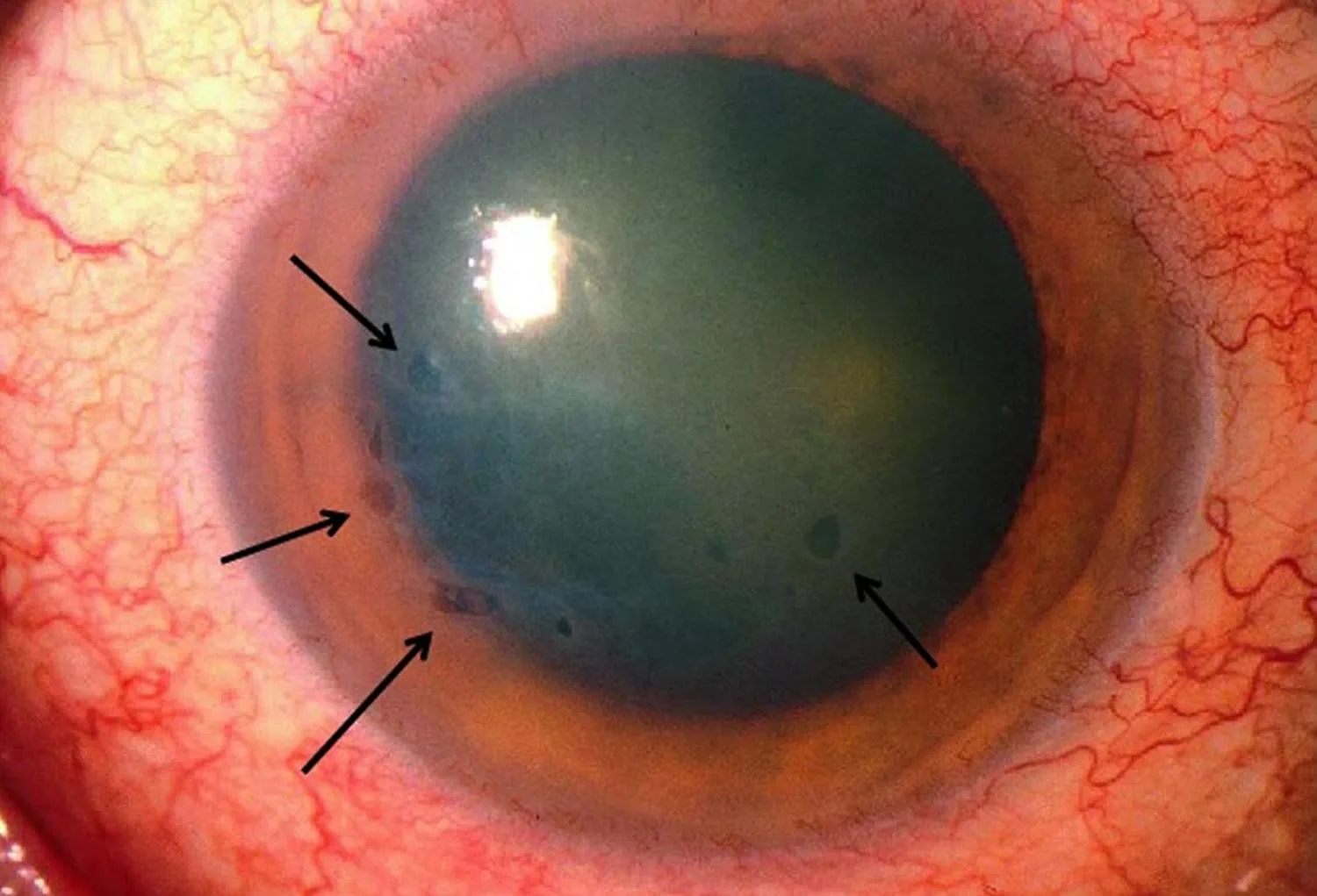 PBK associated with Anterior Chamber IOL (ACIOL)