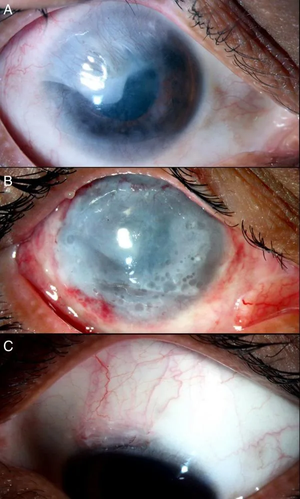 Classic Corneal Edema and Epithelial Bullae
