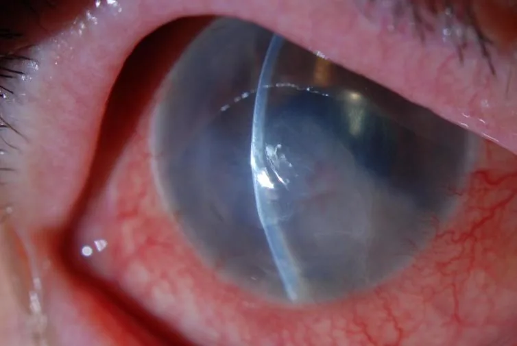 Severe stroma thickening and microcystic edema