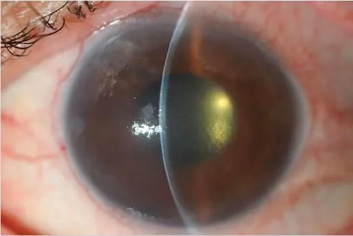 Corneal decompensation (Diffuse haziness)