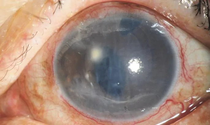 Advanced Pseudophakic Bullous Keratopathy