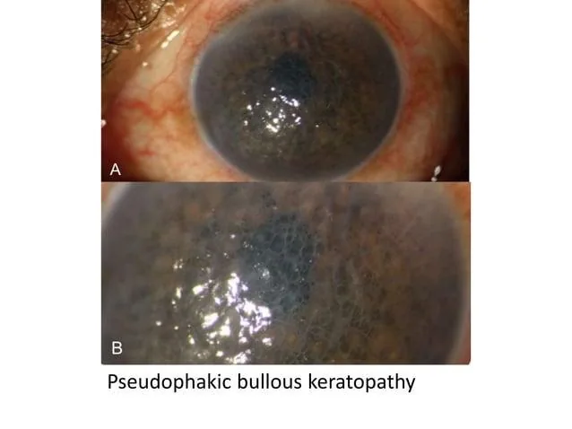 Large epithelial bullae on slit-lamp retroillumination