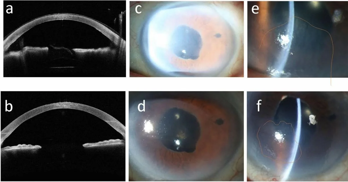 Clinical correlation: Slit-lamp and OCT comparison
