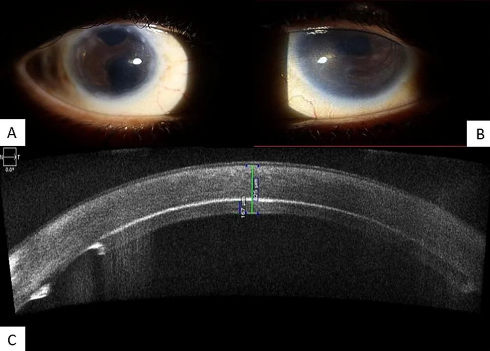 Optical cross-section mapping the extent of edema